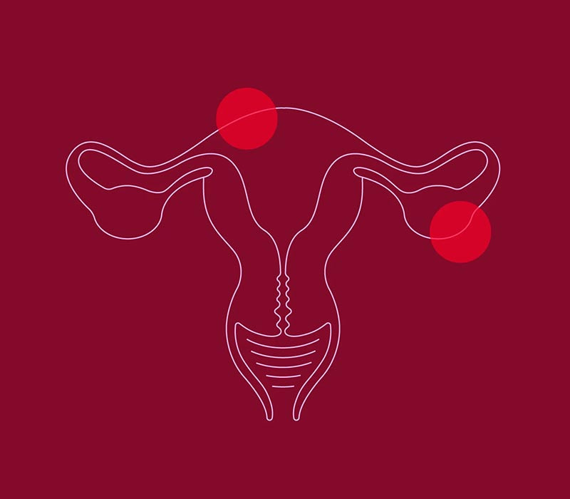 Understanding Endometriosis: What You Need to Know
